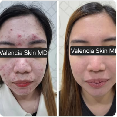 Acne treatment before and after result with identity obscured