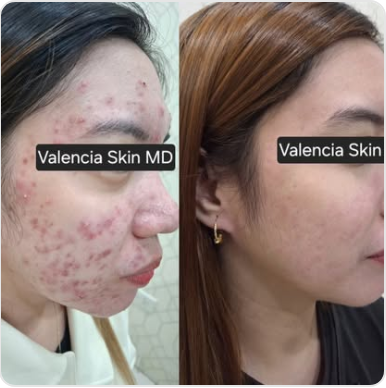 Profile study 01, acne treatment before and after with identity obscured