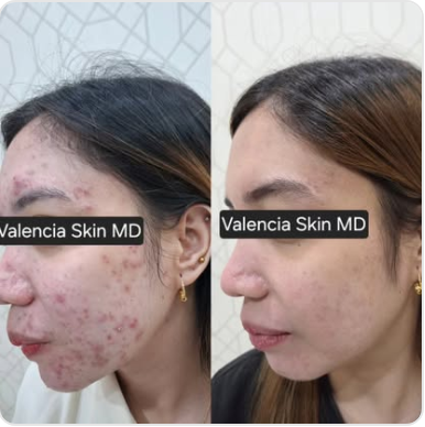 Profile study 02, acne treatment before and after with identity obscured